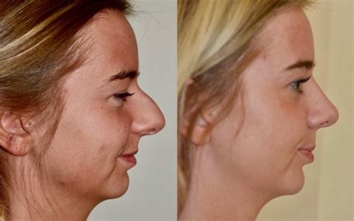 Ice Poseidon Nose Surgery: Before And After Photos
